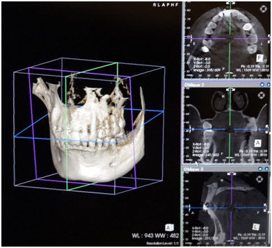 インプラント３ＤＣＴ画面